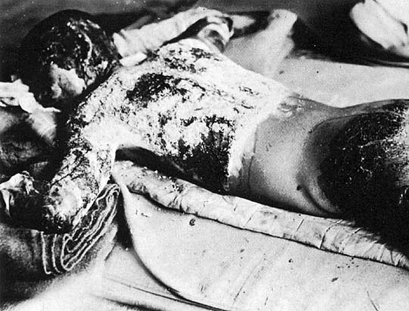 Victim_of_Atomic_Bomb_002 by . 